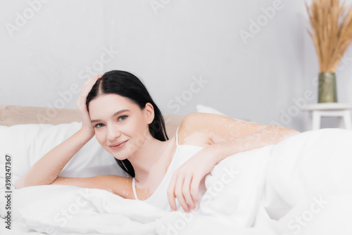 smiling young woman with vitiligo resting and looking at camera in bedroom