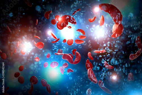 Sickle Cell Anemia 3D Illustration