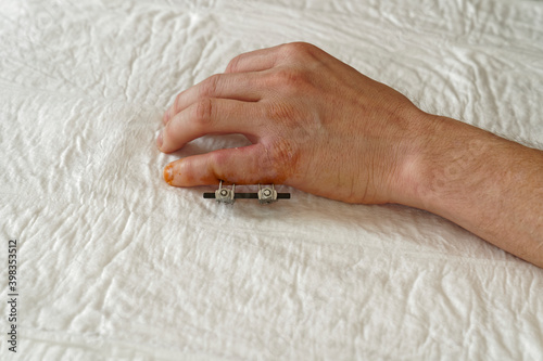 Fixateur externe nach einer OP am kleinen Finger der linken Hand nach einem komplizierten Bruch der Phalanx Basis beim Skifahren