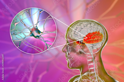 Human brain with highlighted temporal lobe and close-up view of neurons photo