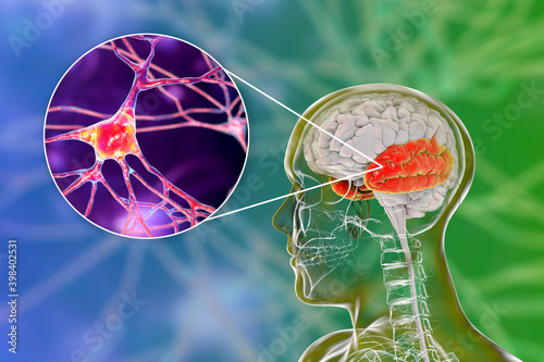 Human brain with highlighted temporal lobe and close-up view of neurons photo