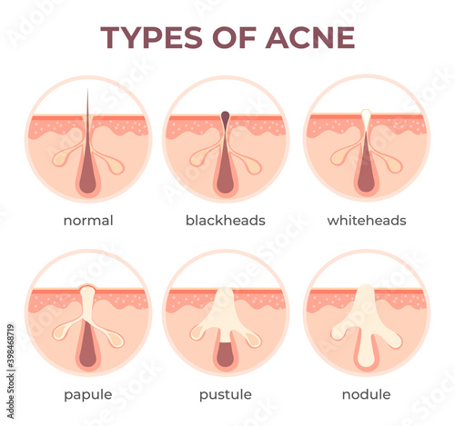 Acne types anatomy. Pimple diseases sectional view blackhead, cystic and whitehead. Structure of skin and pore infection vector infographic photo