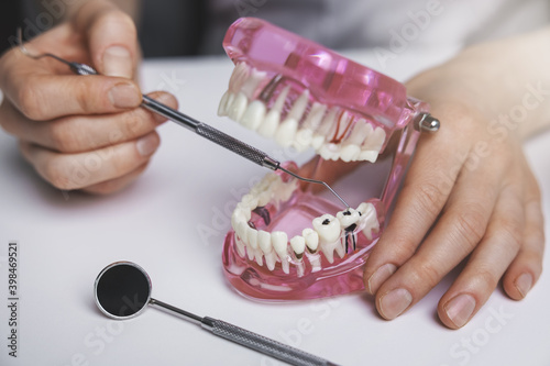 dentist showing dental caries tooth decay on jaw model