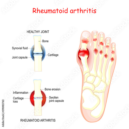 rheumatoid arthritis in joints of human's foot