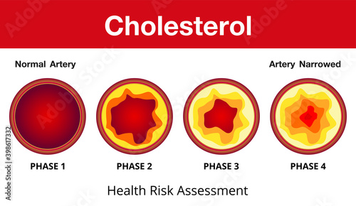 Cholesterol in artery, health risk , vector design