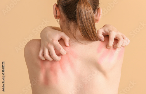 Young allergic woman scratc...