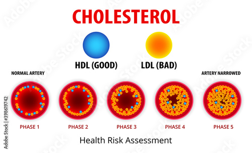 Cholesterol in artery, health risk , vector design