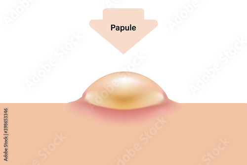 Papule, Skin acne problems, Inflamed acne