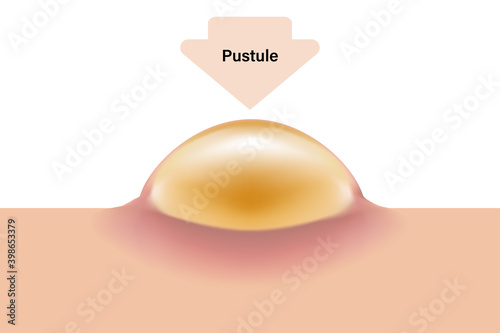 Pustule, Skin acne problems, Inflamed acne
