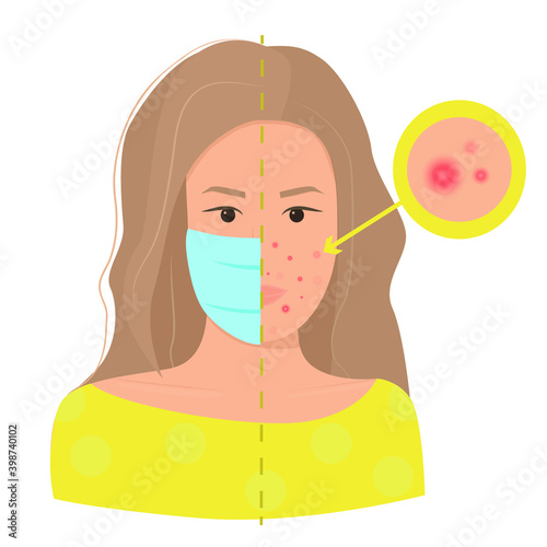 Maskne concept. Acne caused wearing face mask due to coronovirus pandemic. Flat female character portrait struggling with pimples. Acne closeup.  Isolated vector