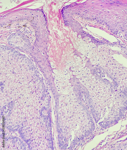 Tablou pe pânză Photo of sebaceous adenoma, magnification 200x, photo under microscope