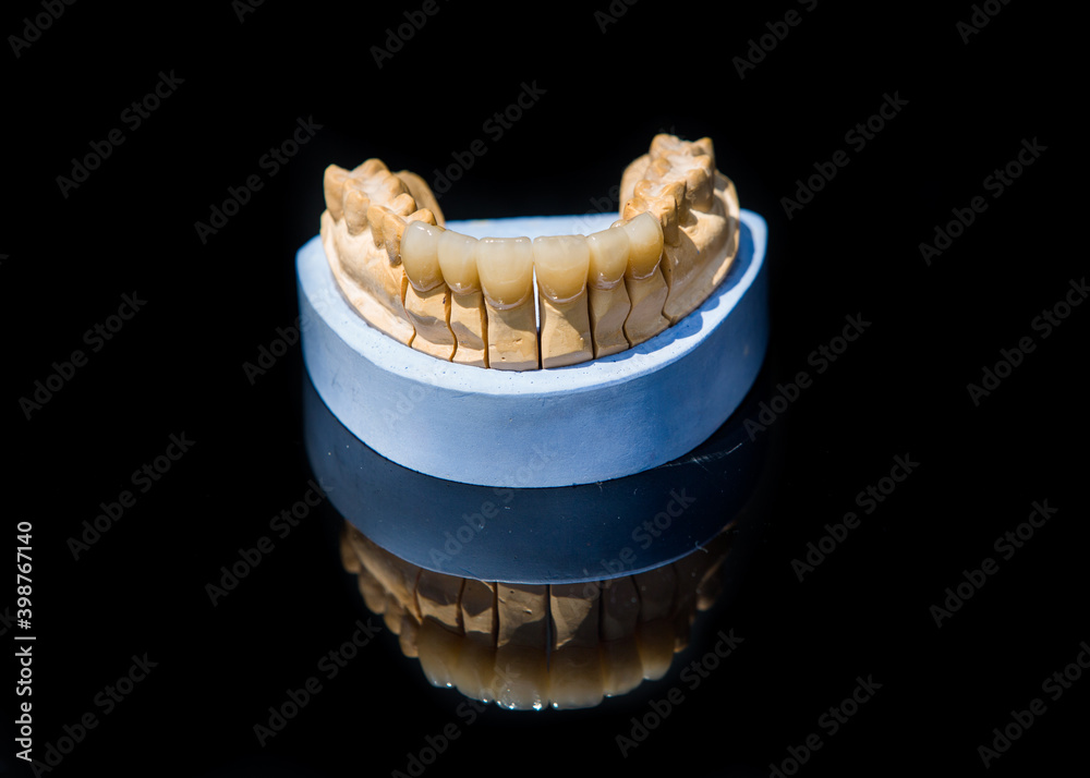 Ceramic teeth dental crowns model on black background.