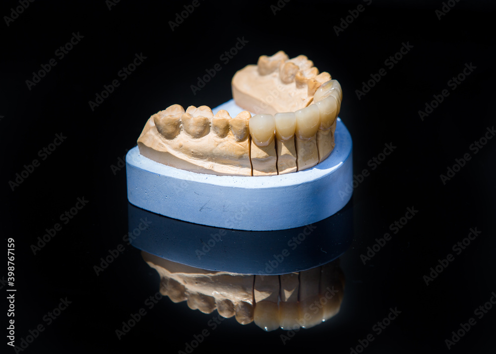 Ceramic teeth dental crowns model on black background.