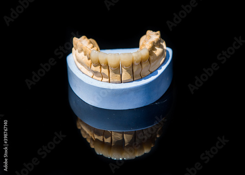 Obraz na płótnie Ceramic teeth dental crowns model on black background. w salonie