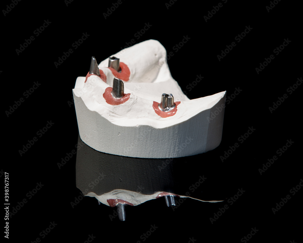Ceramic teeth dental crowns model on black background.