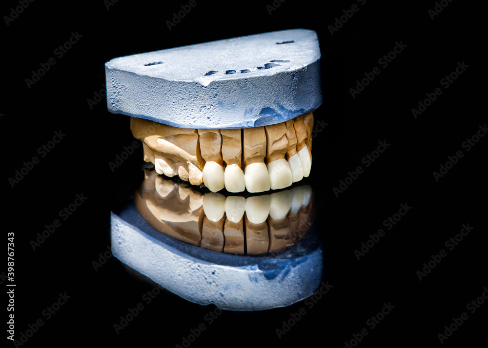 Ceramic teeth dental crowns model on black background.