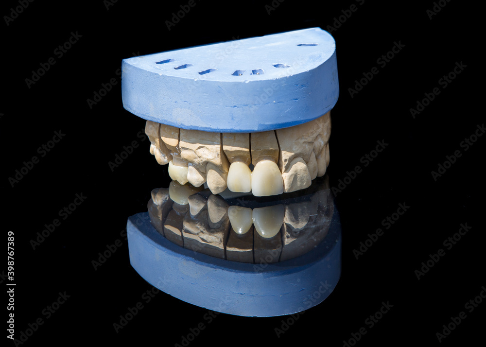 Ceramic teeth dental crowns model on black background.