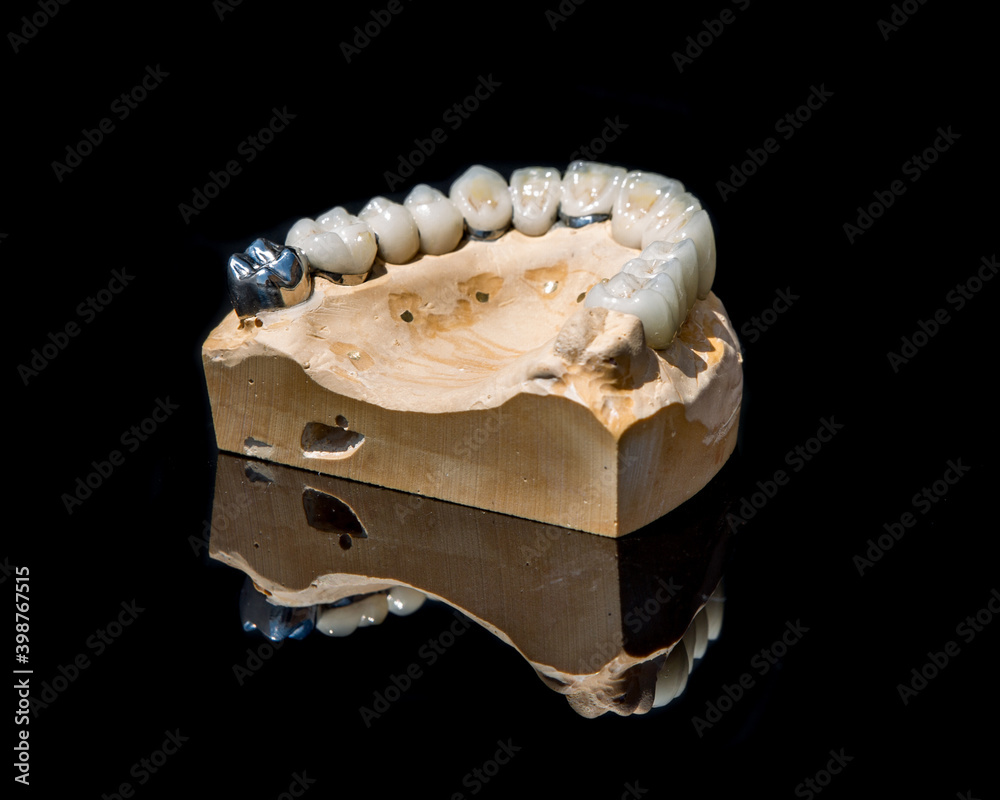 Ceramic teeth dental crowns model on black background.