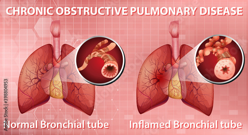 Chronic obstructive pulmonary disease