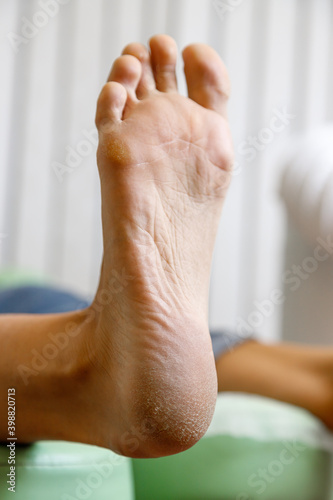 Women's heel close up before pedicure procedure. Professional hardware pedicure in a medical salon. Close up photo. Visiting an orthopedic podiatrist.