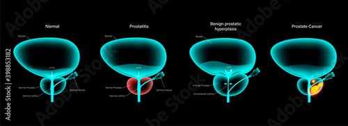 Prostate cancer concept