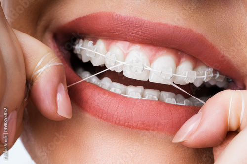 Obraz na plátně Female Cleaning Dental Brackets In Mouth