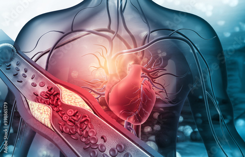 Fototapeta Human heart with blocked arteries. 3d illustration.