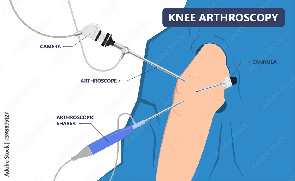 knee torn tear ACL treat kneecap patella pain joint injury range of