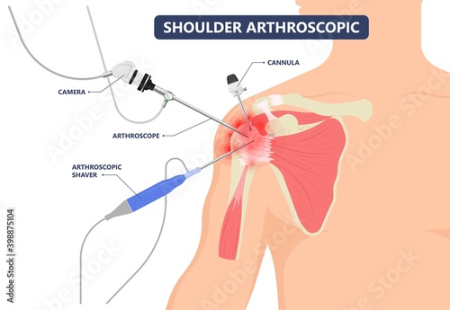 Shoulder Arthroscopy tear cuff repair treat problem joint pain injury disease disorder painful heavy lifting damage tendons Bankart SLAP