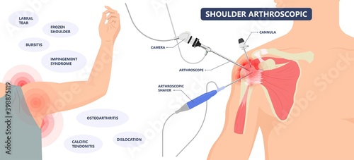 Shoulder Arthroscopy tear cuff repair treat problem joint pain injury disease disorder painful heavy lifting damage tendons Bankart SLAP photo