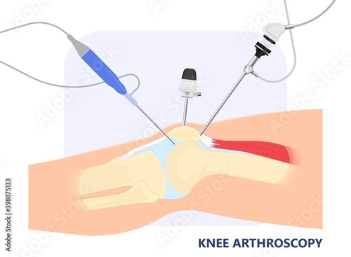 knee torn tear ACL treat kneecap patella pain joint injury range of motion repair bone Plica removal keyhole cyst Baker’s fracture synovium lining problem Sprains strains tendon tibia fibula falling