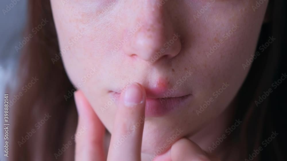 Herpes virus on human lips. Woman touching with hand herpes sore on upper lip on mouth, closeup view. Process of dehydration during illness. Human papilloma virus, viral infection. Herpes virus on human lips. Woman touching with hand herpes sore on upper lip on mouth, closeup view. Process of dehydration during illness. Human papilloma virus, viral infection.