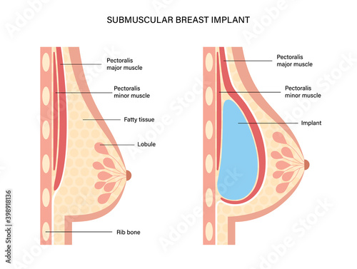 Breast Implant Concept