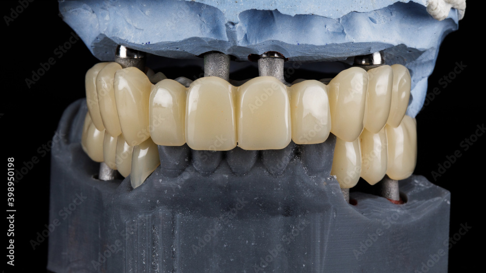 temporary denture and crowns, shown in occlusion on models temporary denture and crowns, shown in occlusion on models