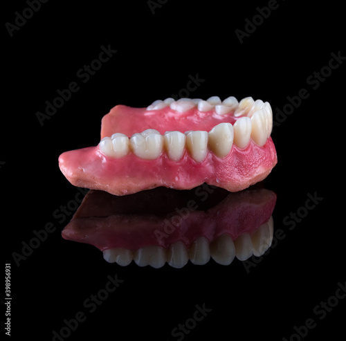 Complete maxillary denture – Wax-Up and Gingival Contouring