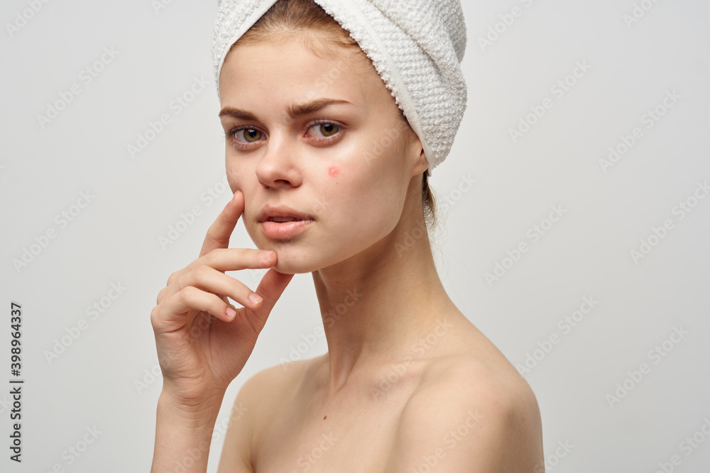 attractive woman with towel on head naked shoulders pimples on face acne skin care attractive woman with towel on head naked shoulders pimples on face acne skin care
