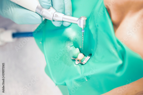 Treatment of dental canals in the bottom molar permanent molar using an apex locator file, a tooth with a clip attached to it with a cofferdam. photo