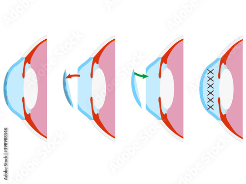 Vector illustration: keratoplasty. Corneal surgery. Eye surgery.