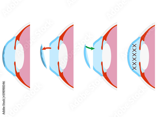 Vector illustration: keratoplasty. Corneal surgery. Eye surgery. photo