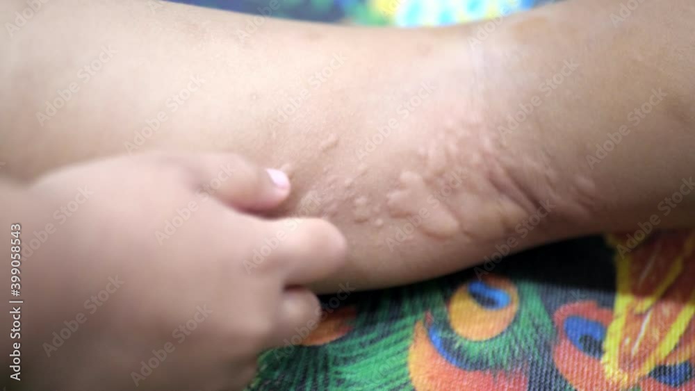 Slow motion scene of A 5-year-old girl has an allergic itch in her leg. Slow motion scene of A 5-year-old girl has an allergic itch in her leg.