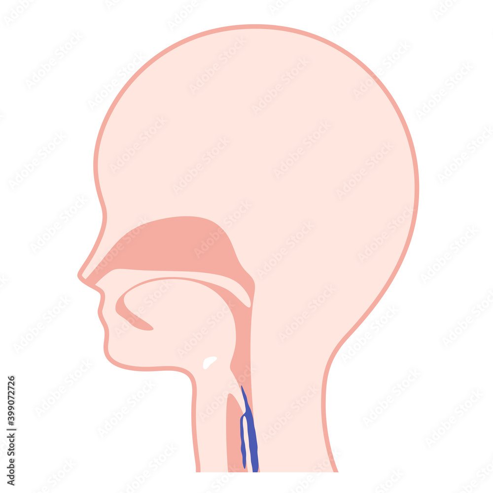 誤嚥のイラスト_嚥下障害 誤嚥のイラスト_嚥下障害