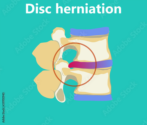 An intervertebral disc herniation flat illustration. Inflamed disc causing pain and discomfort. Degenerative process in spine. Educational medical information.