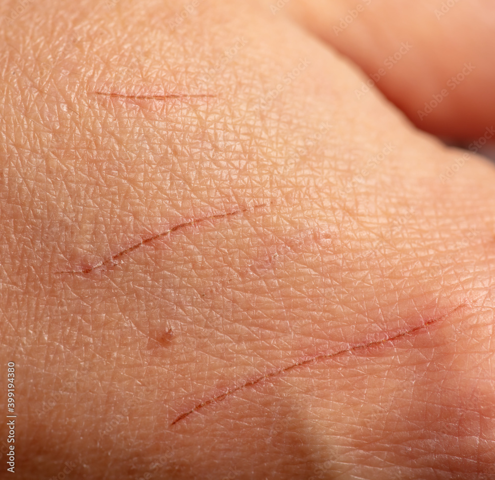 Scratches from the claws of a cat on human skin. Scratches from the claws of a cat on human skin.