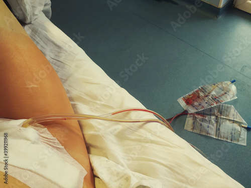 Female patient in hospital after surgery with drainage photo