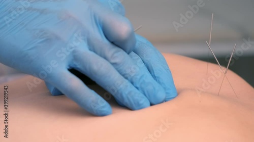Hands of doctor acupuncturist inserts acupuncture needles to woman's back, closeup side view. Woman patient is lying on couch in hospital. Chinese medicine in European world.