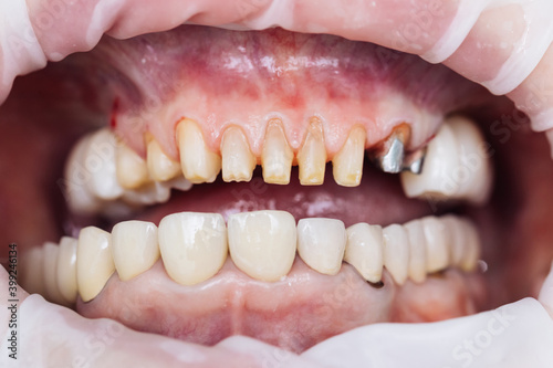 Teeth during dental treatment. Close-up. Dentistry. Patient at the dentist office. Female teeth macro zirconium. Closeup photo with zirconium artificial teeth. Zirconia bridge with porcelain.