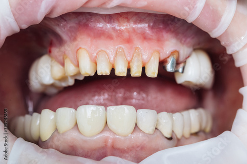 Close-up Dentistry Patient at the dentist office. Female teeth macro zirconium. Closeup photo with zirconium artificial teeth. Zirconia bridge with porcelain