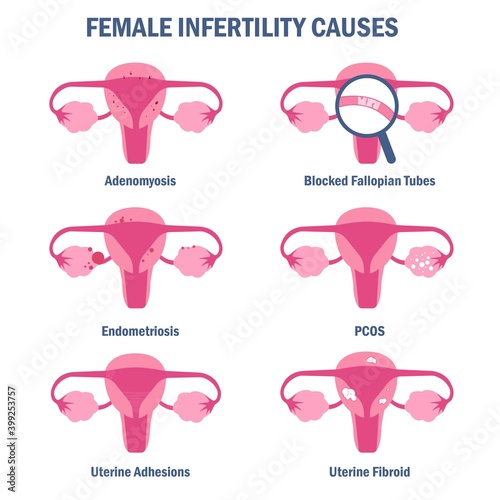 Common causes of female infertility vector illustration photo