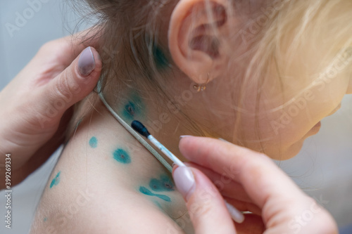 Photos Doctor examining and treats acne with brilliant green a child covered with green rashes on stomach ill with chickenpox, measles or rubella virus