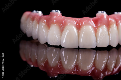 Beautiful upper teeth ceramic press ceramic crowns and veneers on the dental stone model zircon arch ceramic prothesis Implants . Dental restoration treatment clinic patient. oral surgery dentist